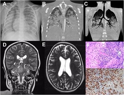 Two Brothers with Atypical UNC13D-Related Hemophagocytic Lymphohistiocytosis Characterized by Massive Lung and Brain Involvement